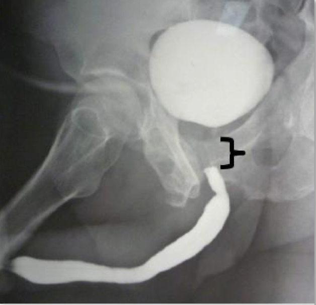 Retrograde urethrogram showing posterior urethral disruption with gap between urethra and bladder